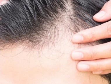 Αυτές είναι οι πέντε βασικές αιτίες που έχετε τριχόπτωση